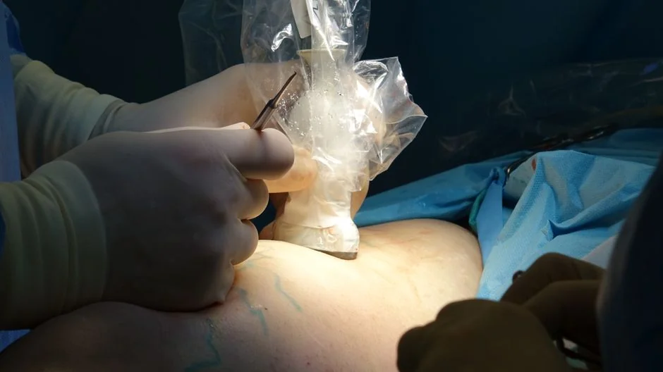 Long-term results of liposuction tightening Tokyo: — How Liposuction Works: The Biology of Fat Removal and Skin R