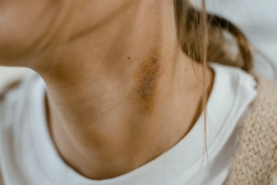 Melasma treatment Tokyo: causes and solutions — Cost of Melasma Treatment in Tokyo