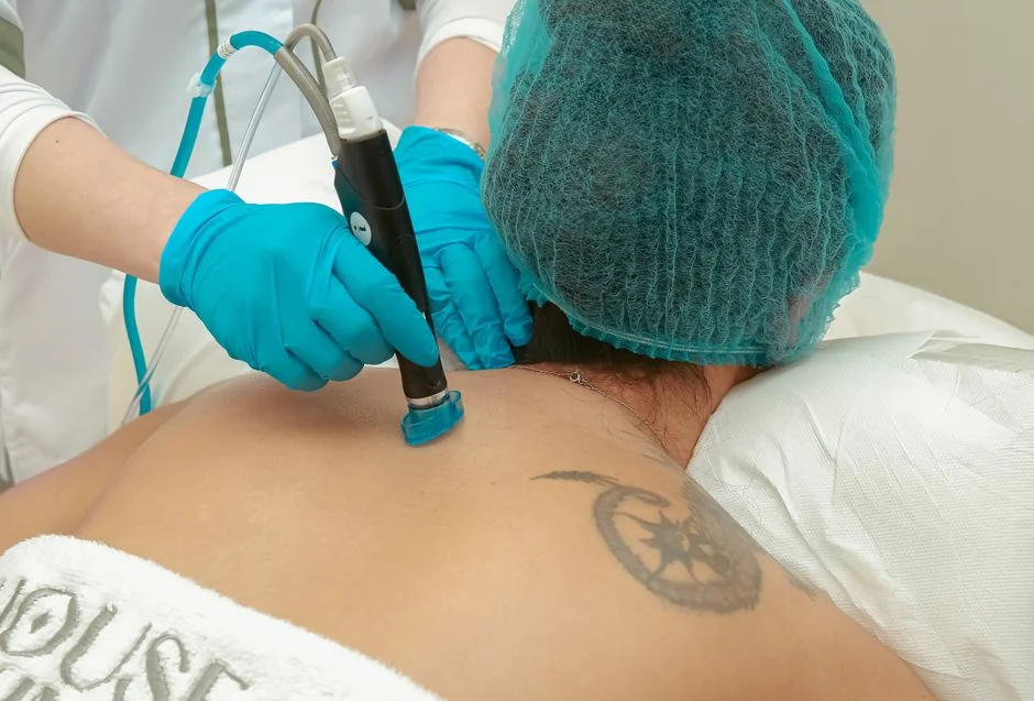 Mole removal Tokyo: cost and procedure at a Japane — Mole Removal Methods: How Each Procedure Works