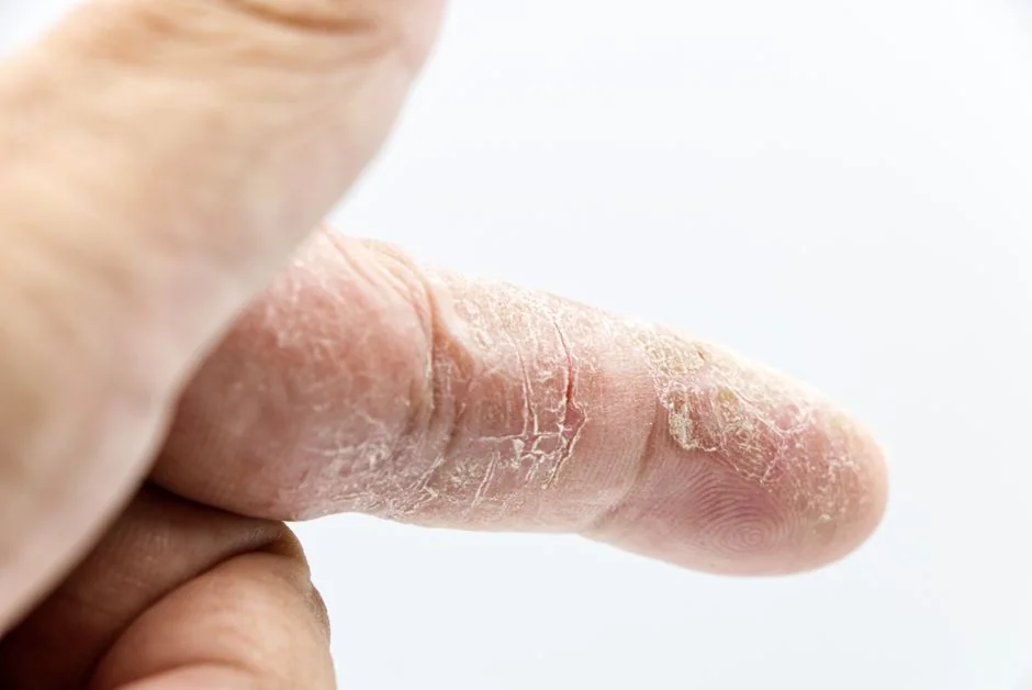 Eczema treatment Tokyo: options for foreigners — What Is Eczema and Why Does Tokyo Trigger It