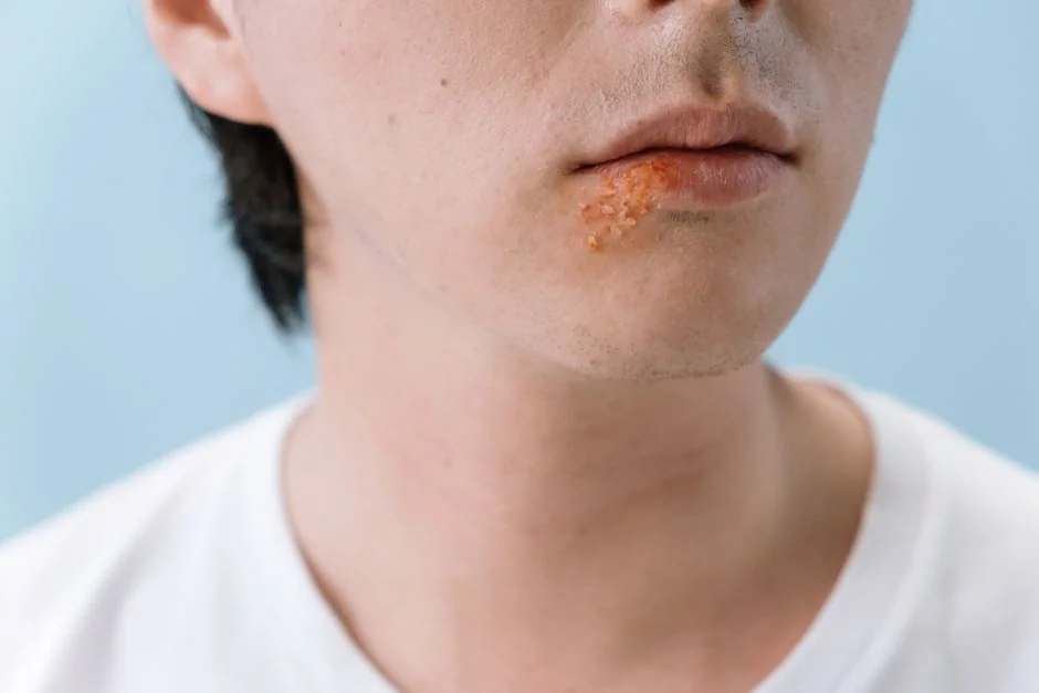 Eczema treatment Tokyo: options for foreigners — Eczema Treatment Options Available in Tokyo