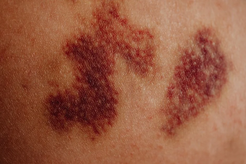 Scar revision surgery Tokyo: options and cost — What to Expect: Before, During and After