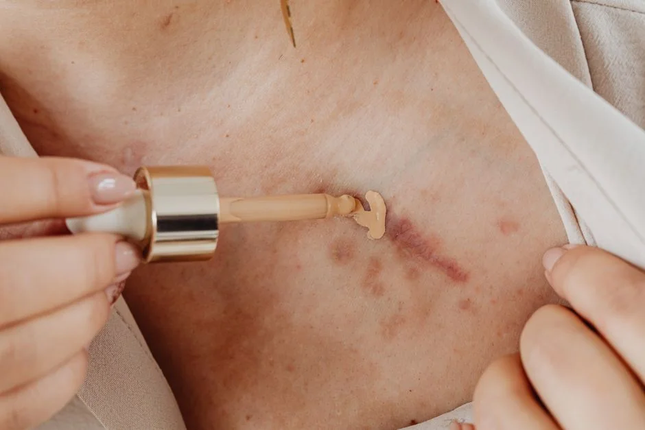 Scar revision surgery Tokyo: options and cost — What Is Scar Revision Surgery