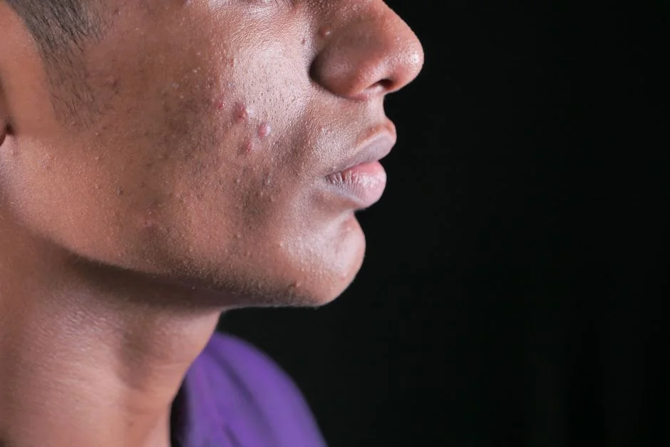Acne treatment at a Tokyo dermatologist: what to e — Understanding Acne: What a Dermatologist Actually Looks For Acne treatment at a Tokyo dermatologist: what to e — Understanding Acne: What a Dermatologist Actually Looks For