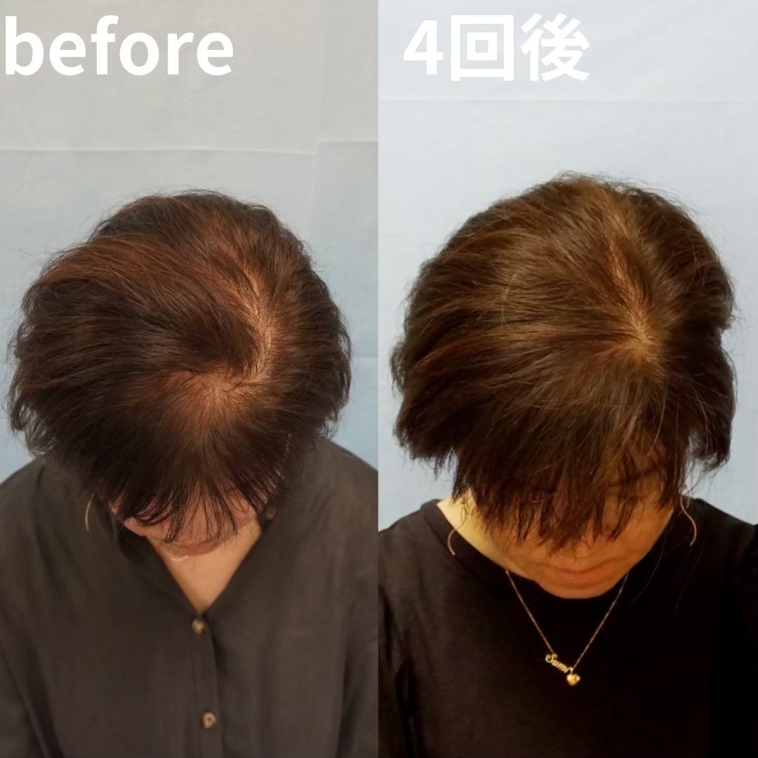 AGA dutasteride treatment before and after — English-speaking Tokyo clinic