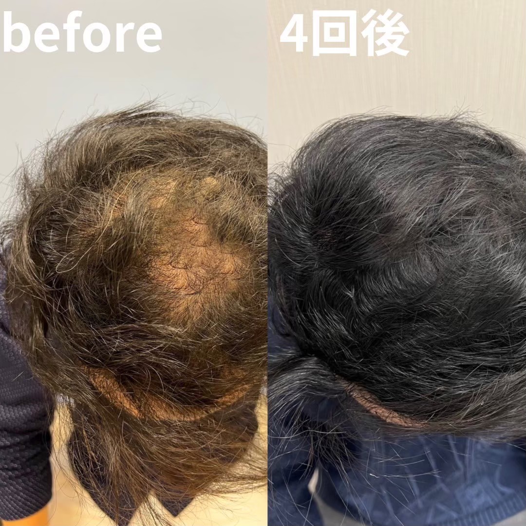 AGA hair mesotherapy result — Tokyo scalp regenerative treatment case