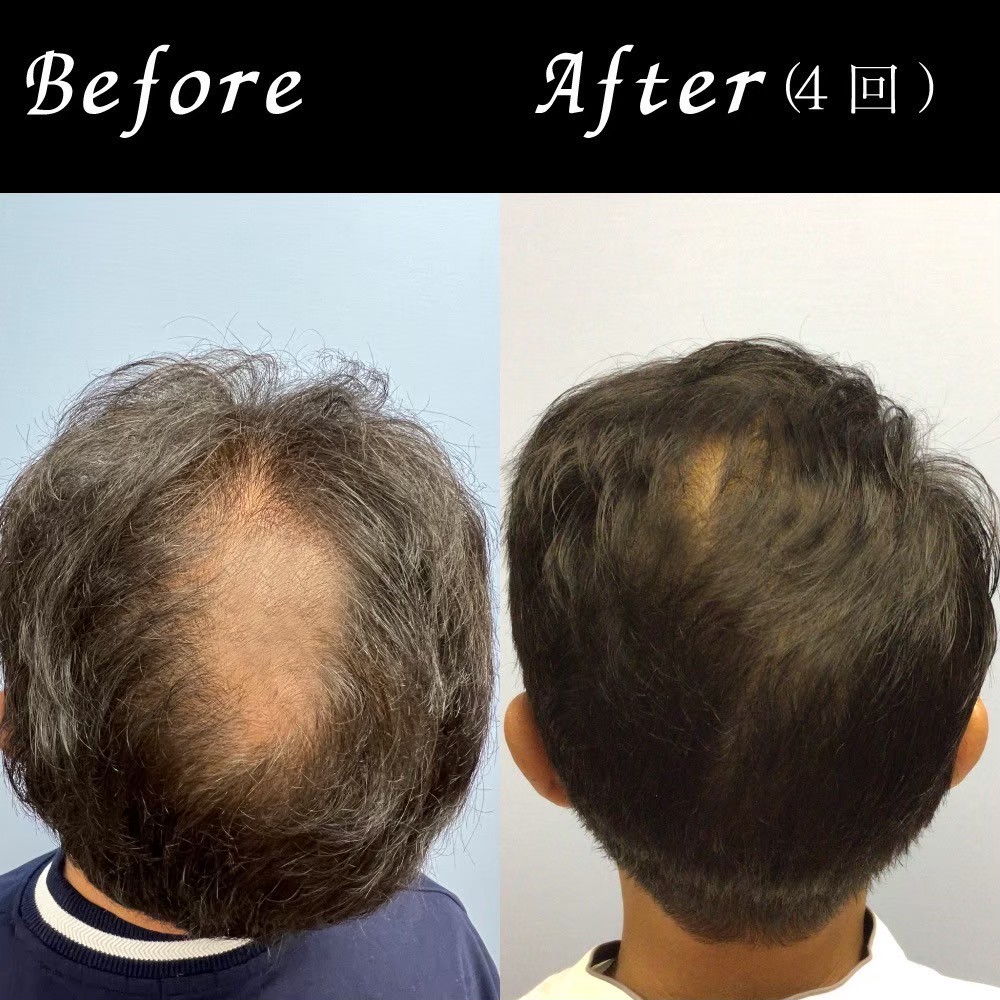 AGA combination therapy result — Dr. Jun Karibe, board-certified plastic surgeon