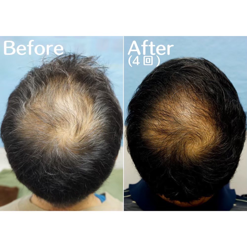 AGA dutasteride treatment before and after — English-speaking Tokyo clinic