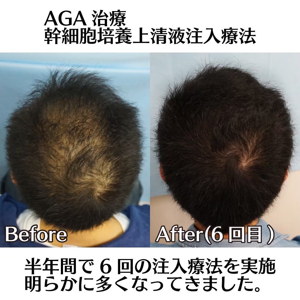 AGA finasteride result — Kojimachi Dermatology Clinic Tokyo case photo
