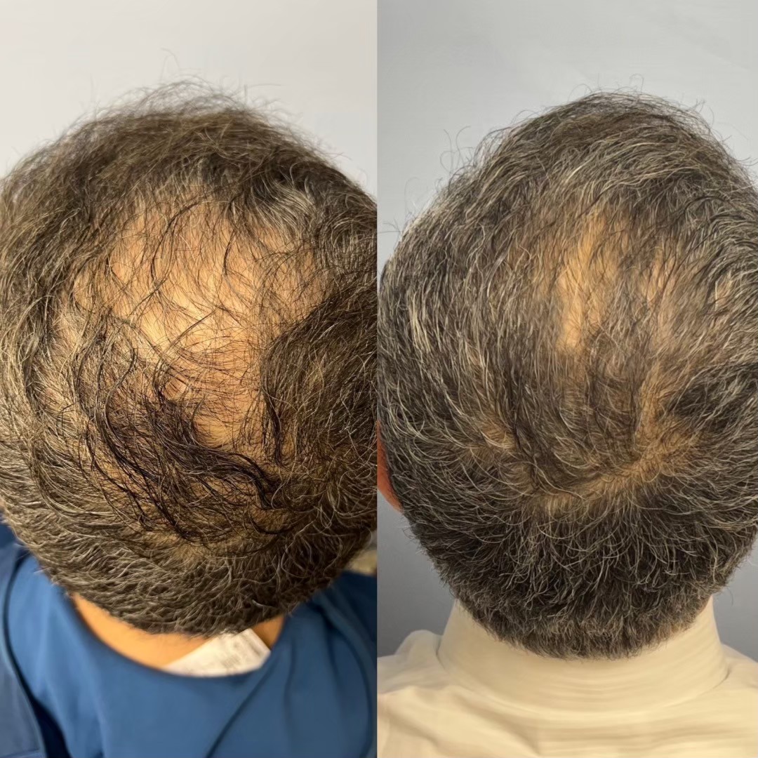 Androgenetic alopecia treatment before/after — BIOTOPE Clinic Shirokanedai