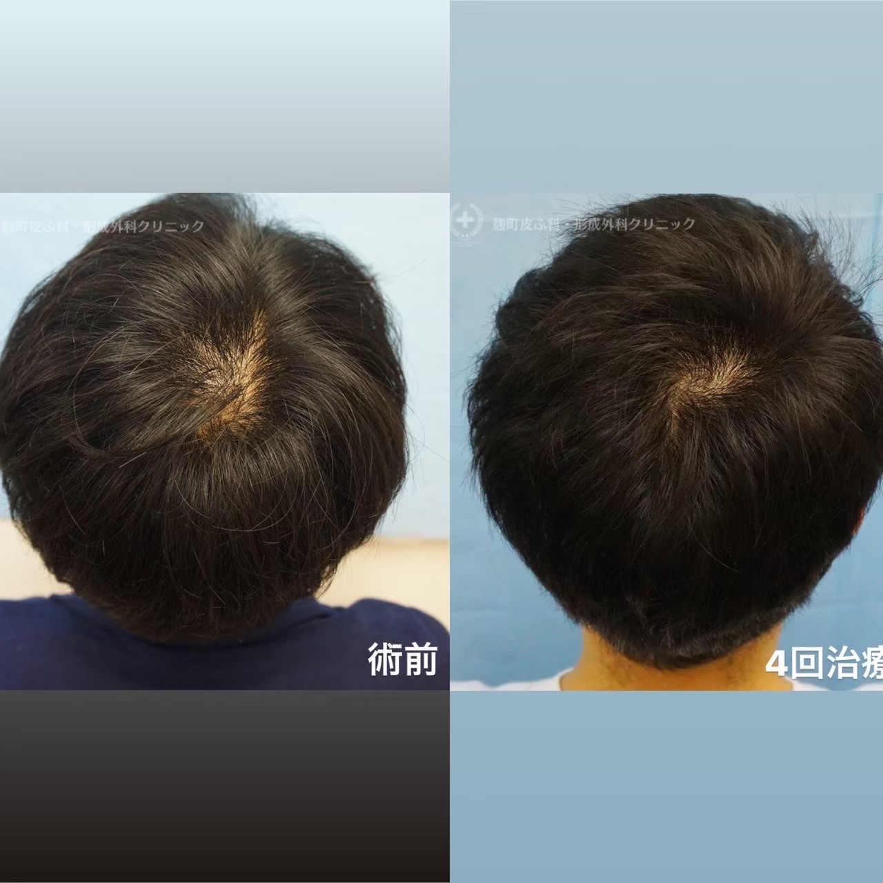 AGA minoxidil hair regrowth result — Tokyo dermatology case study
