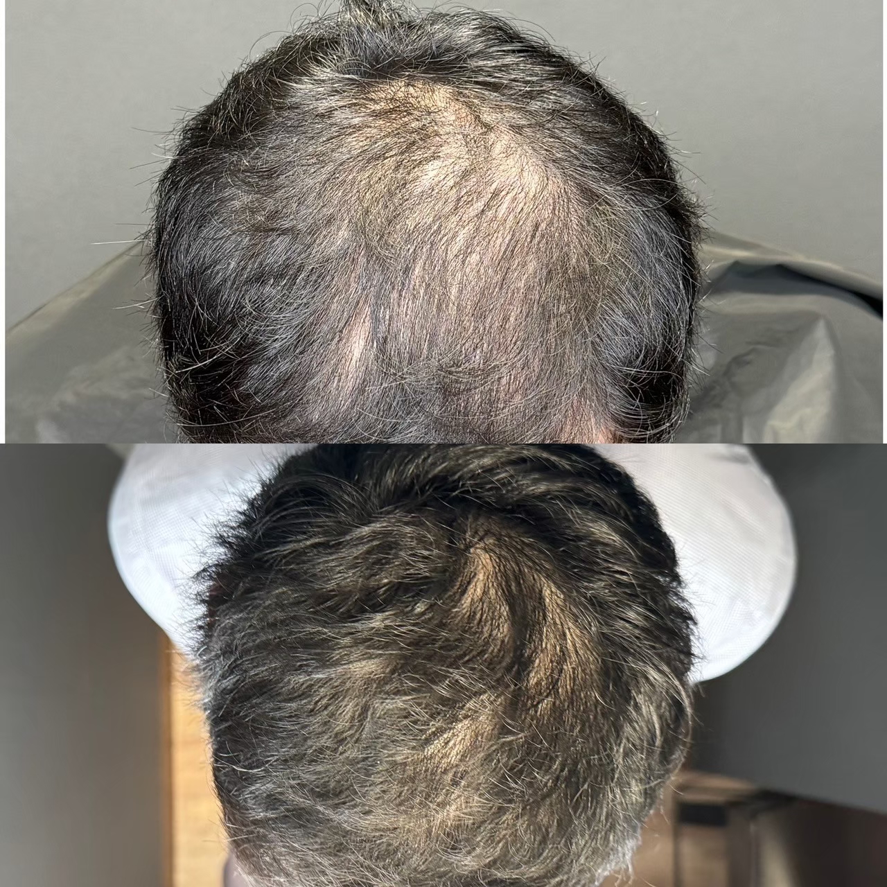 AGA before and after — male pattern hair loss treatment result Tokyo