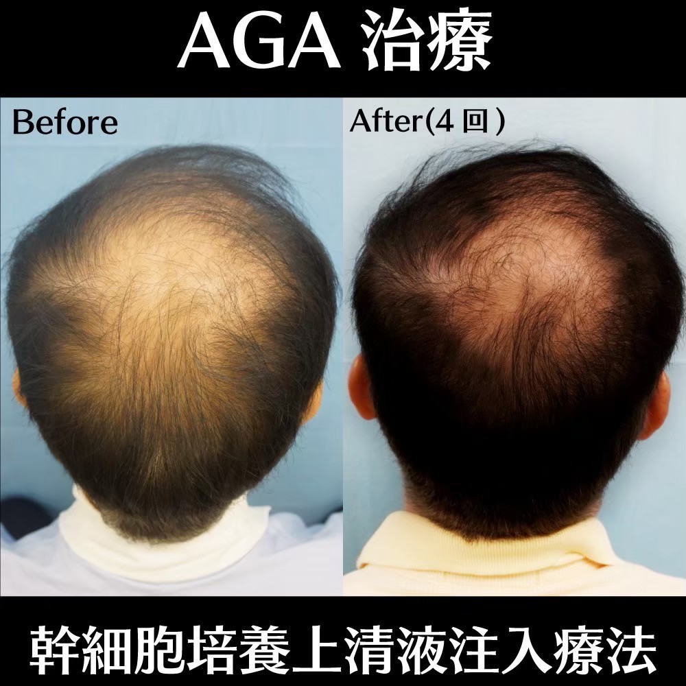 AGA combination therapy result — Dr. Jun Karibe, board-certified plastic surgeon