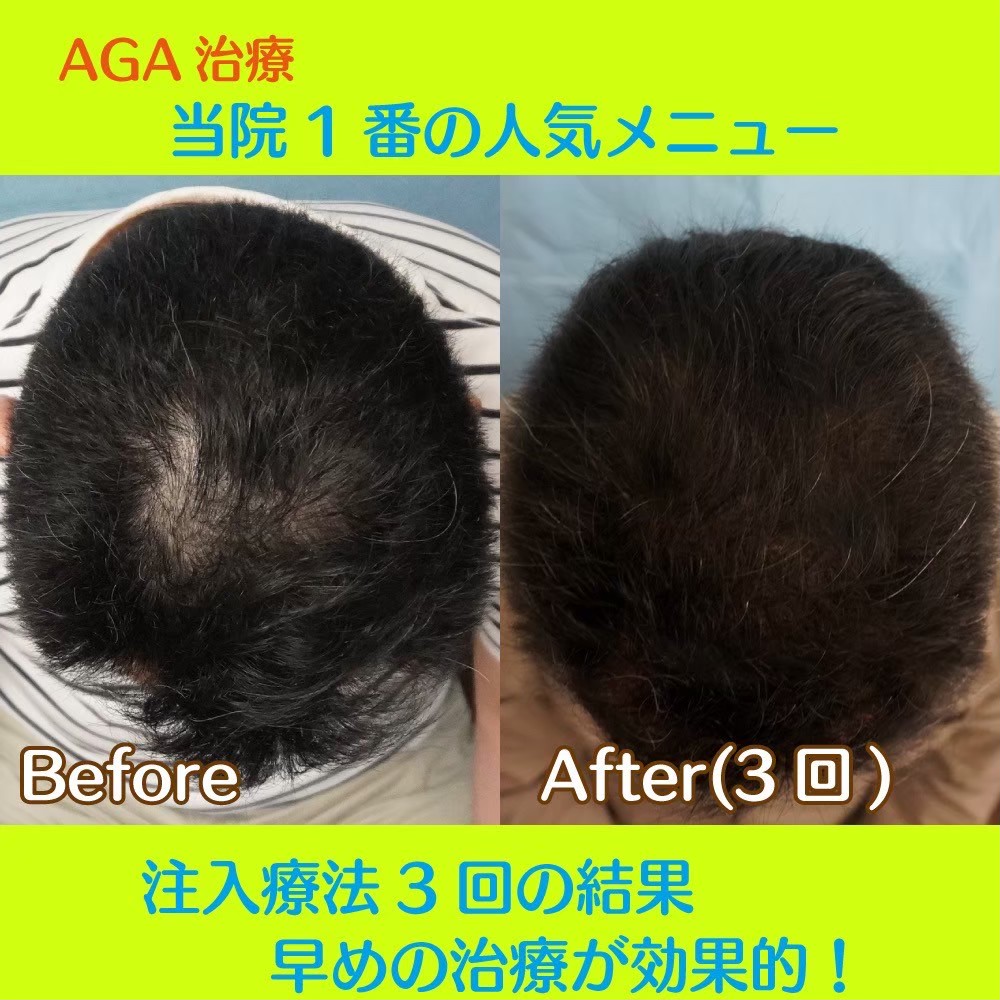 AGA finasteride result — Kojimachi Dermatology Clinic Tokyo case photo