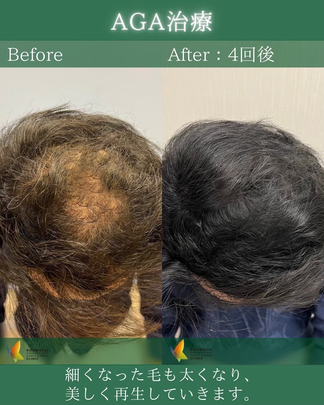AGA patient case — Tokyo cosmetic dermatology, board-certified physician