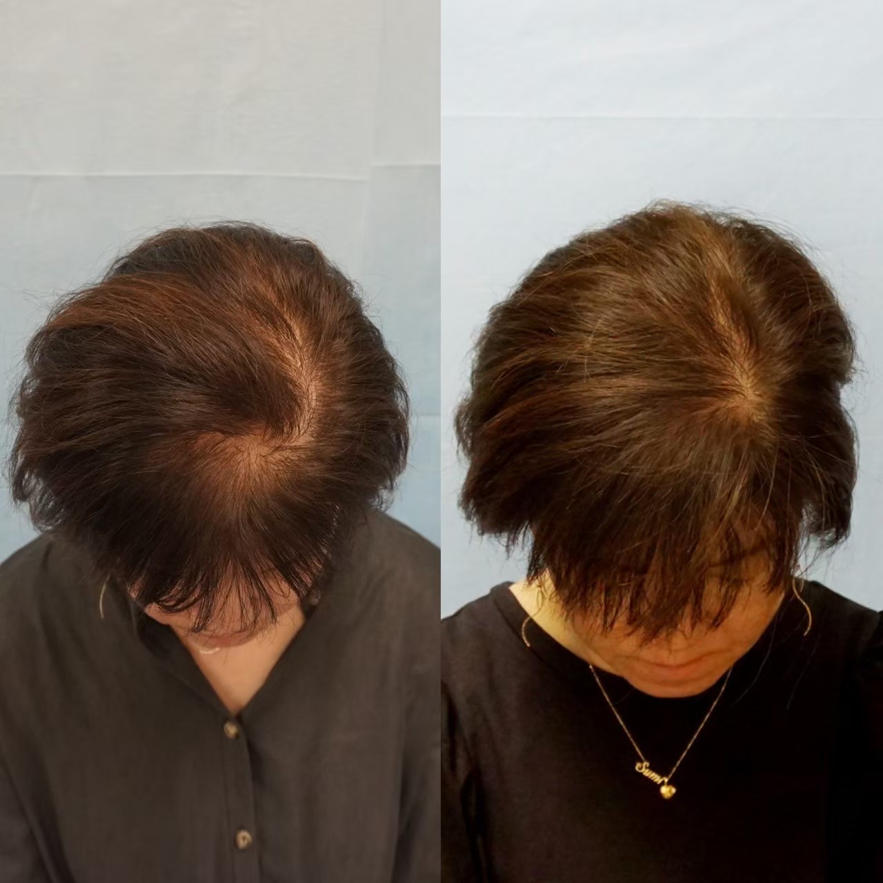 AGA minoxidil hair regrowth result — Tokyo dermatology case study