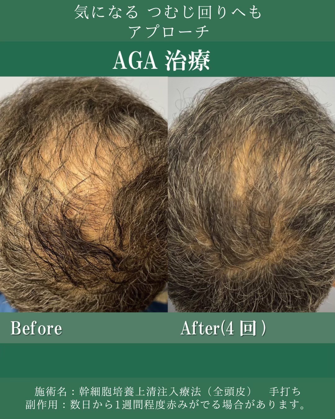 AGA scalp coverage improvement — Kojimachi Clinic, English care