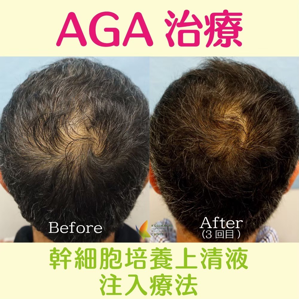 Hair loss treatment result Tokyo — Dr. Karibe, English-speaking AGA clinic