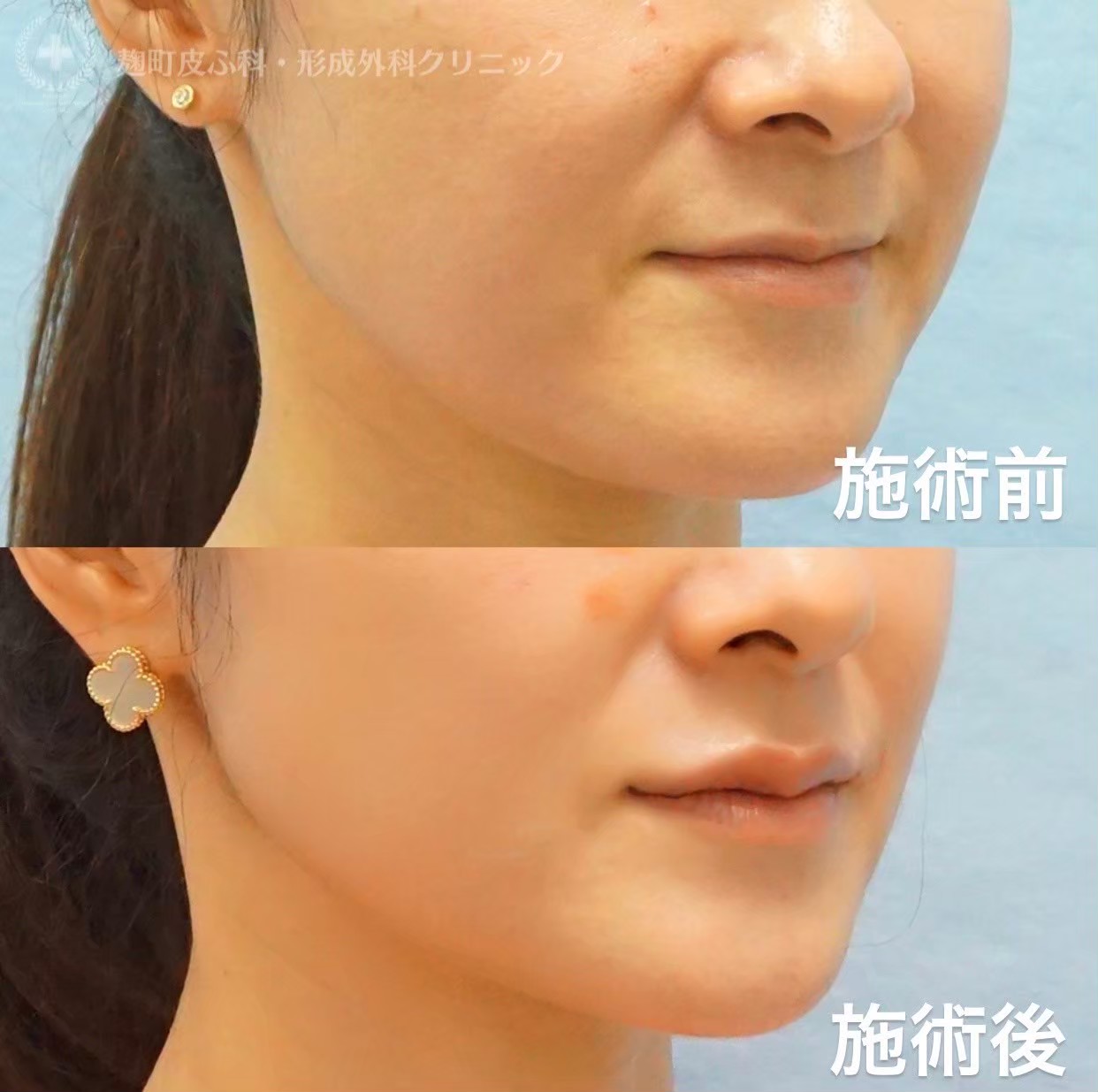 Natural lip filler before/after — BIOTOPE Clinic Shirokanedai