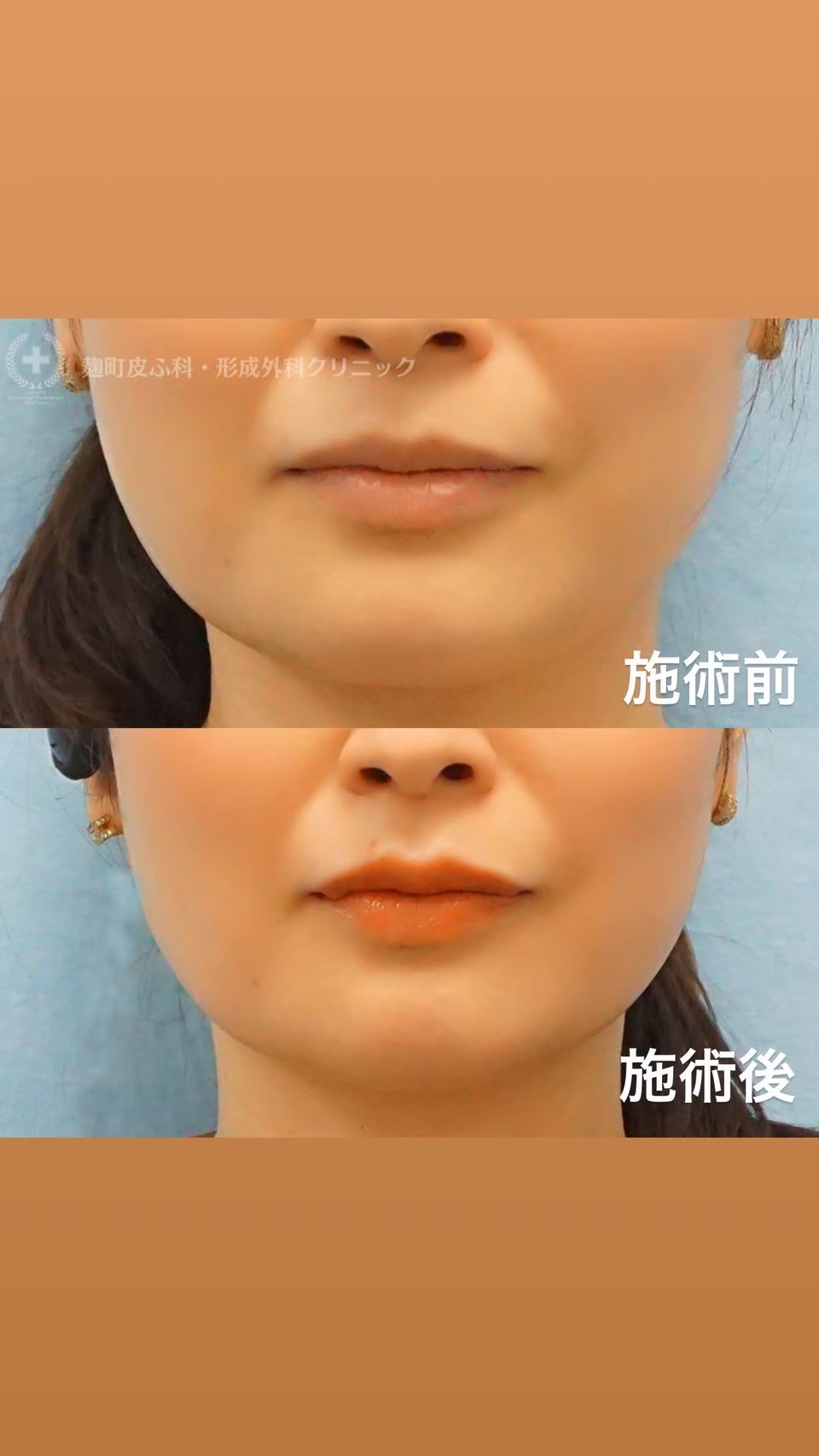Lip augmentation before and after — English-speaking Tokyo clinic