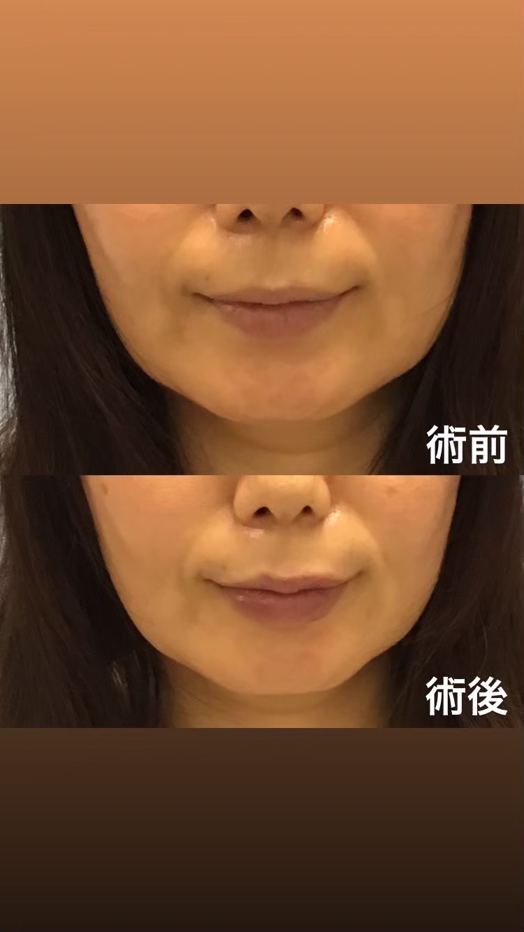 HA lip filler result — Kojimachi Dermatology Clinic Tokyo case photo