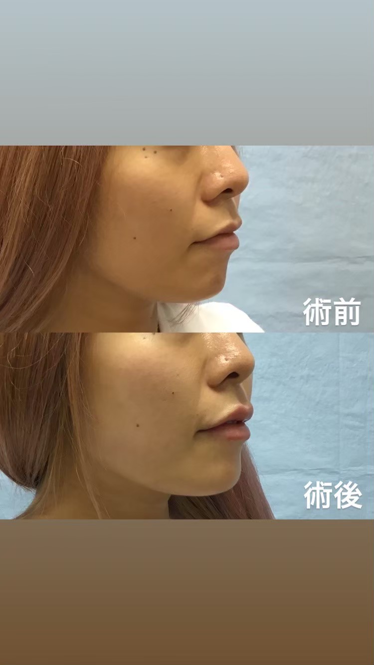 Hyaluronic acid lip enhancement result — Tokyo aesthetic clinic case study