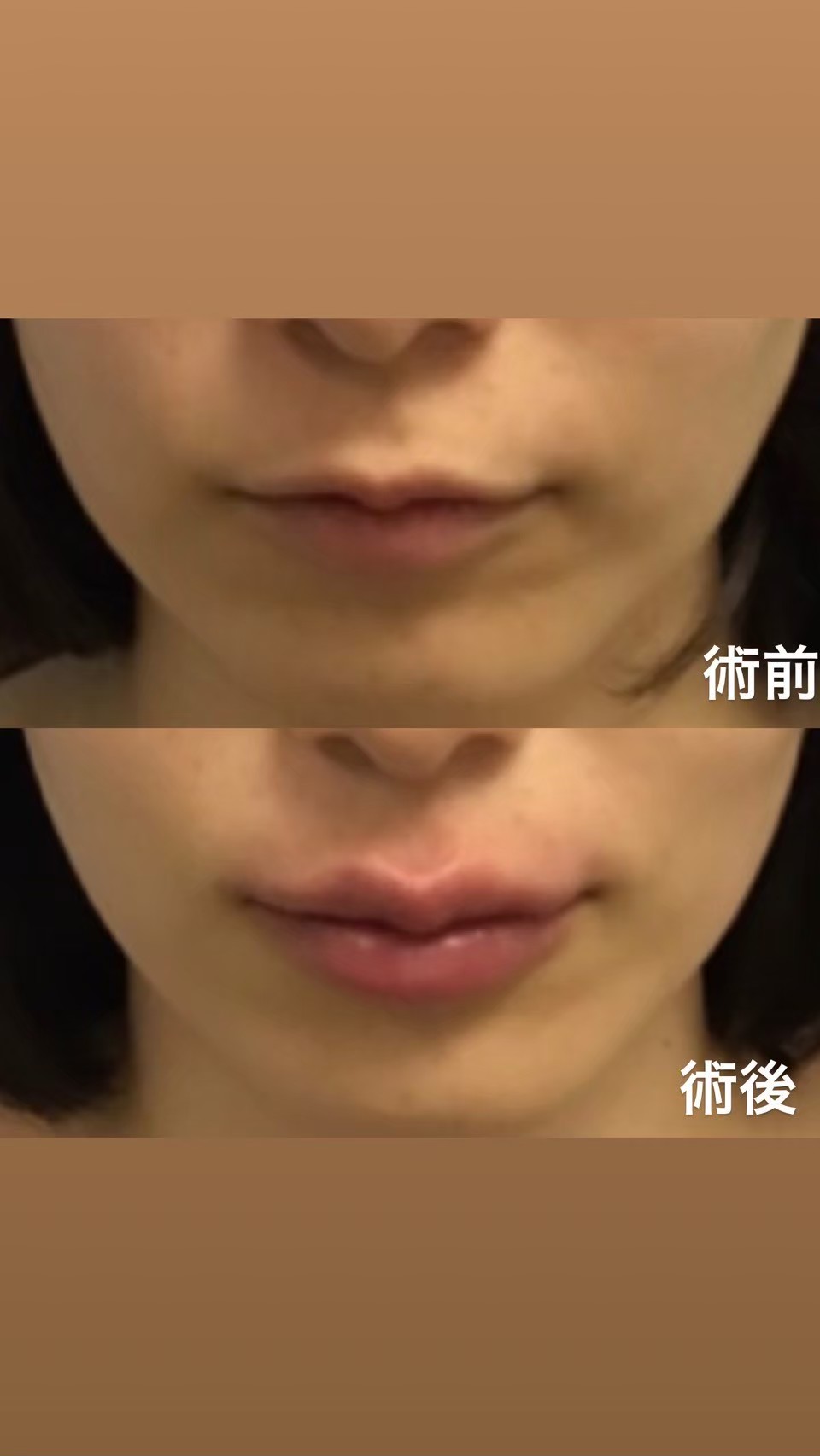 Lip filler result by Dr. Jun Karibe — board-certified plastic surgeon Tokyo