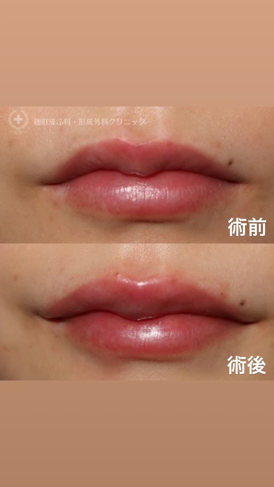 Lip filler before and after — hyaluronic acid lip enhancement result Tokyo