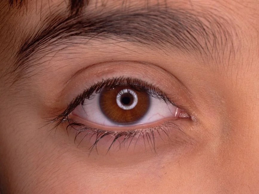 Double eyelid revision surgery Tokyo: correcting o — Expected Results Double eyelid revision surgery Tokyo: correcting o — Expected Results
