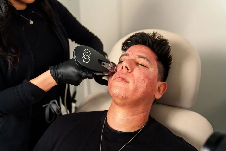 How to treat facial sagging: HIFU vs RF microneedl — What Is RF Microneedling and How Does It Work