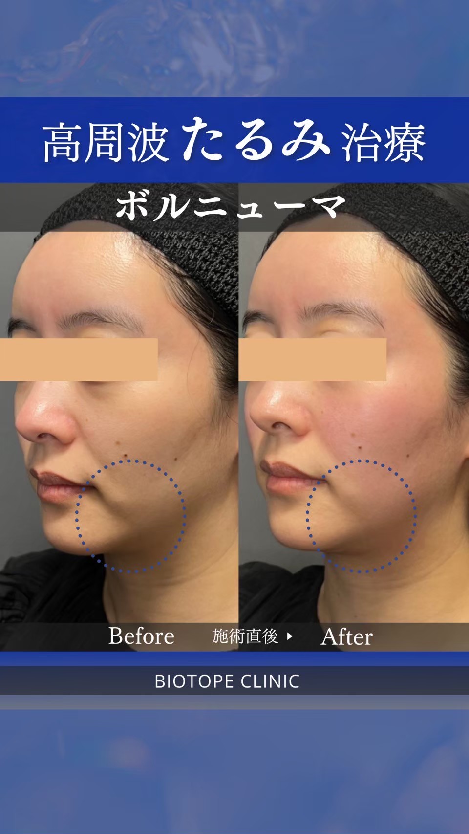 Volnewmer facial rejuvenation result — English-speaking Tokyo clinic