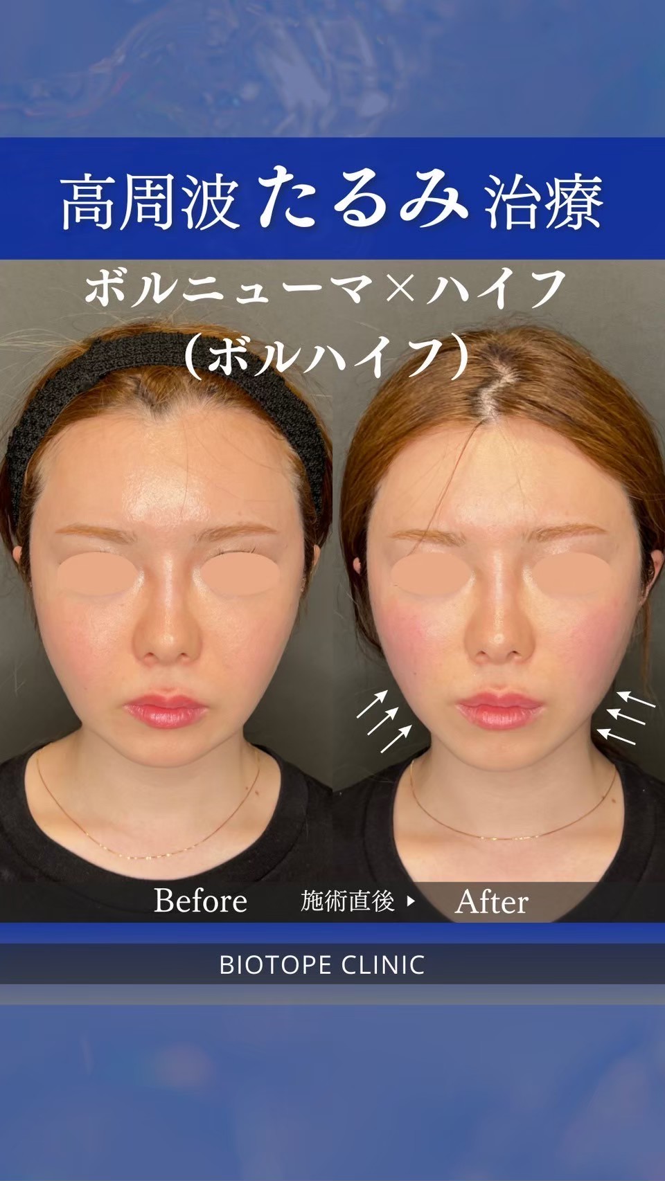 Volnewmer facial rejuvenation result — English-speaking Tokyo clinic