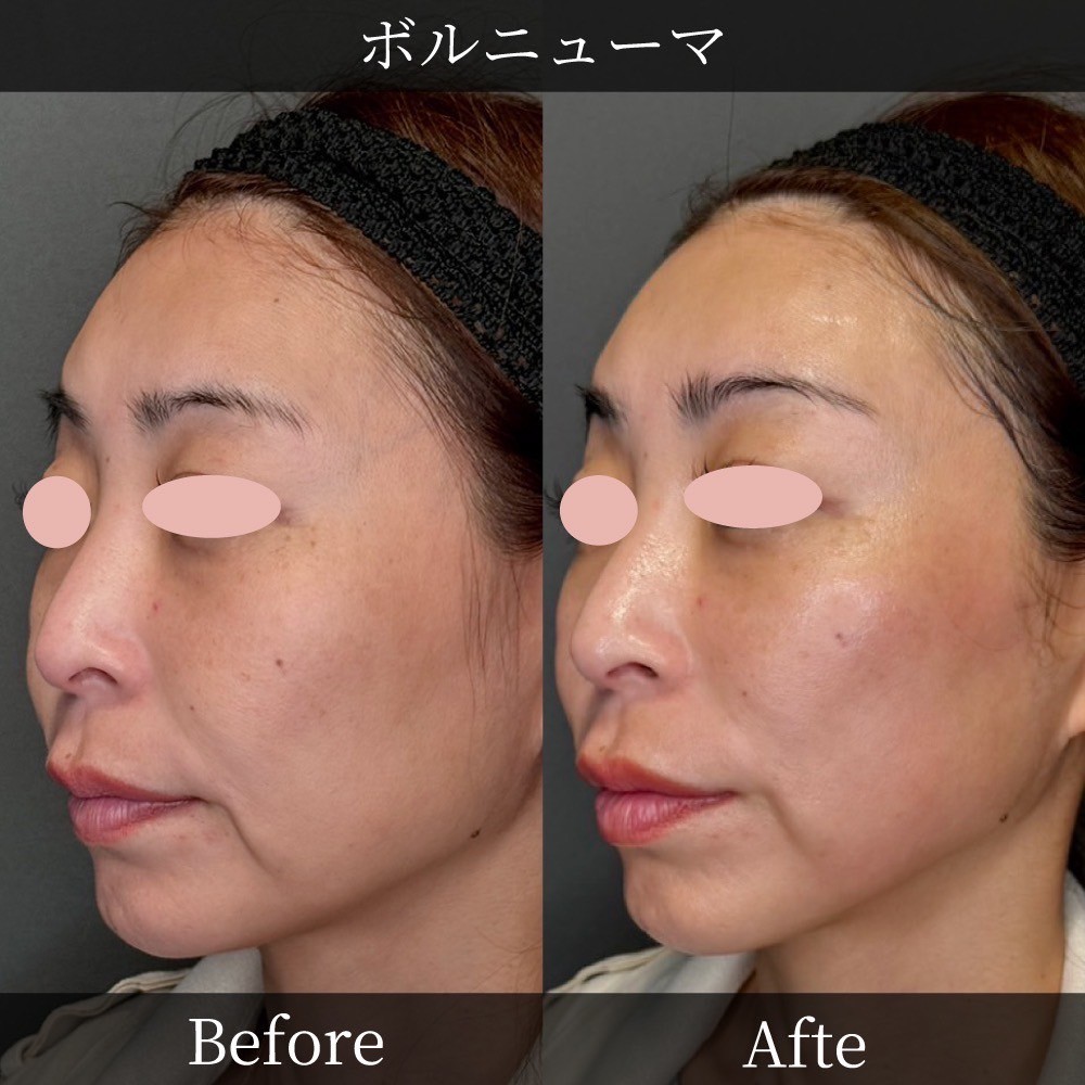Volnewmer RF wrinkle and sagging treatment — Tokyo clinic case study