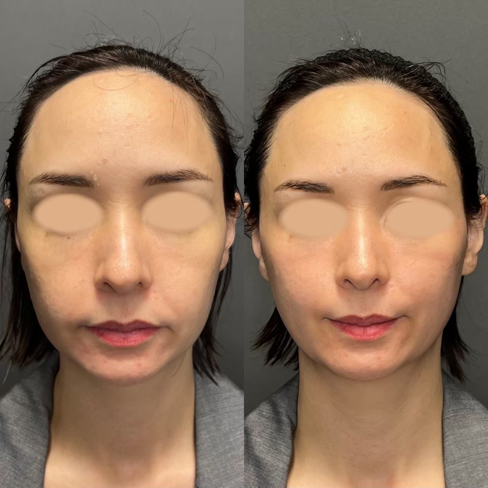 Volnewmer collagen remodeling result — RF skin tightening Japan
