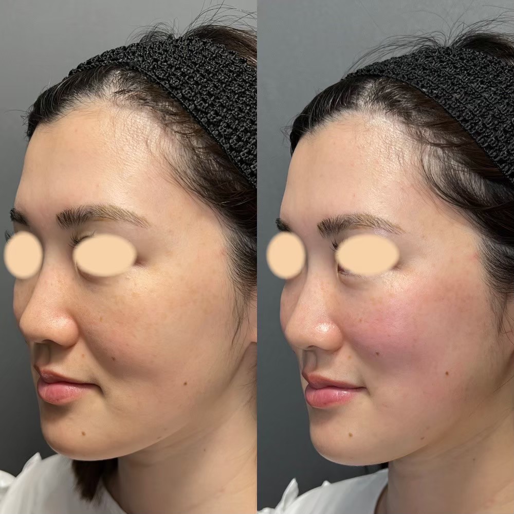 Volnewmer before and after — RF skin tightening result at BIOTOPE Clinic Tokyo