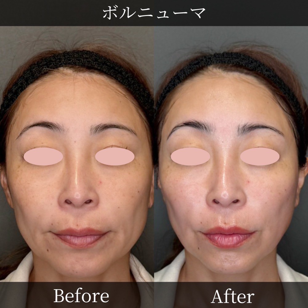 Volnewmer before and after — RF skin tightening result at BIOTOPE Clinic Tokyo