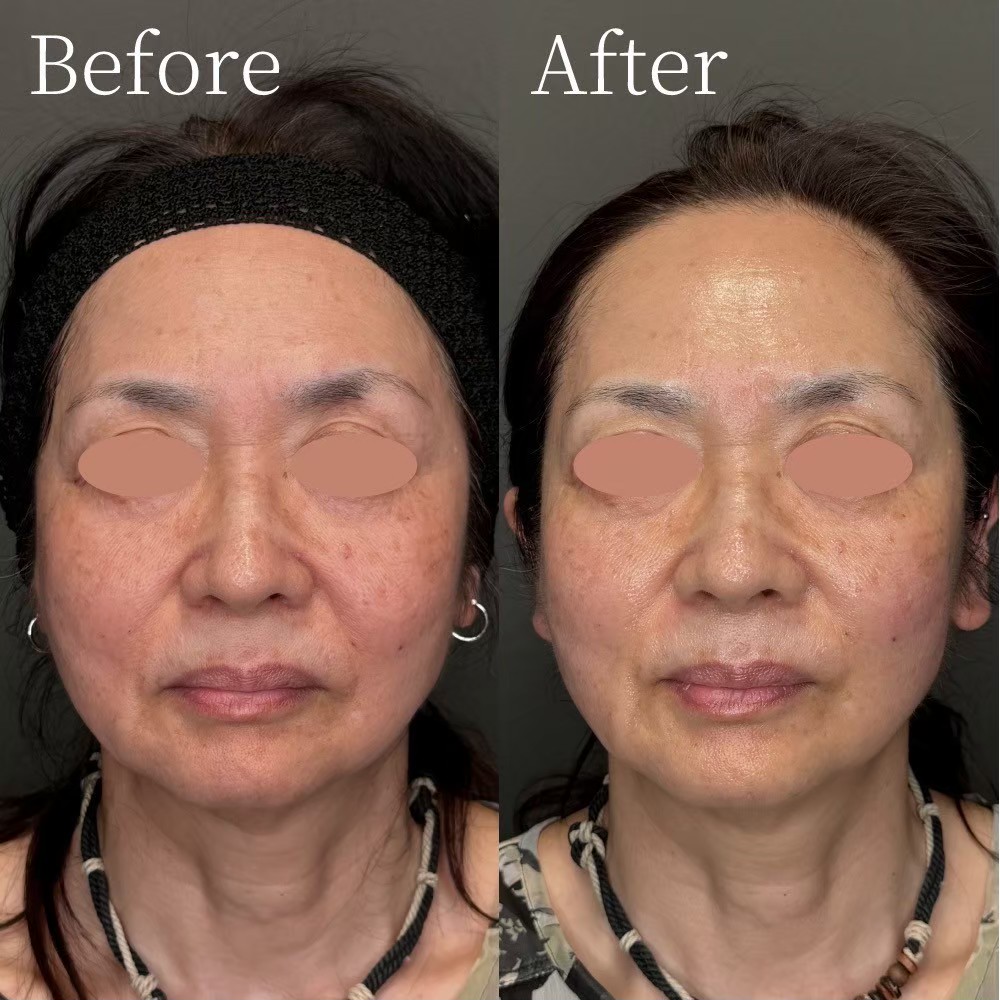 Volnewmer cheek and lower-face tightening — before/after photo Tokyo