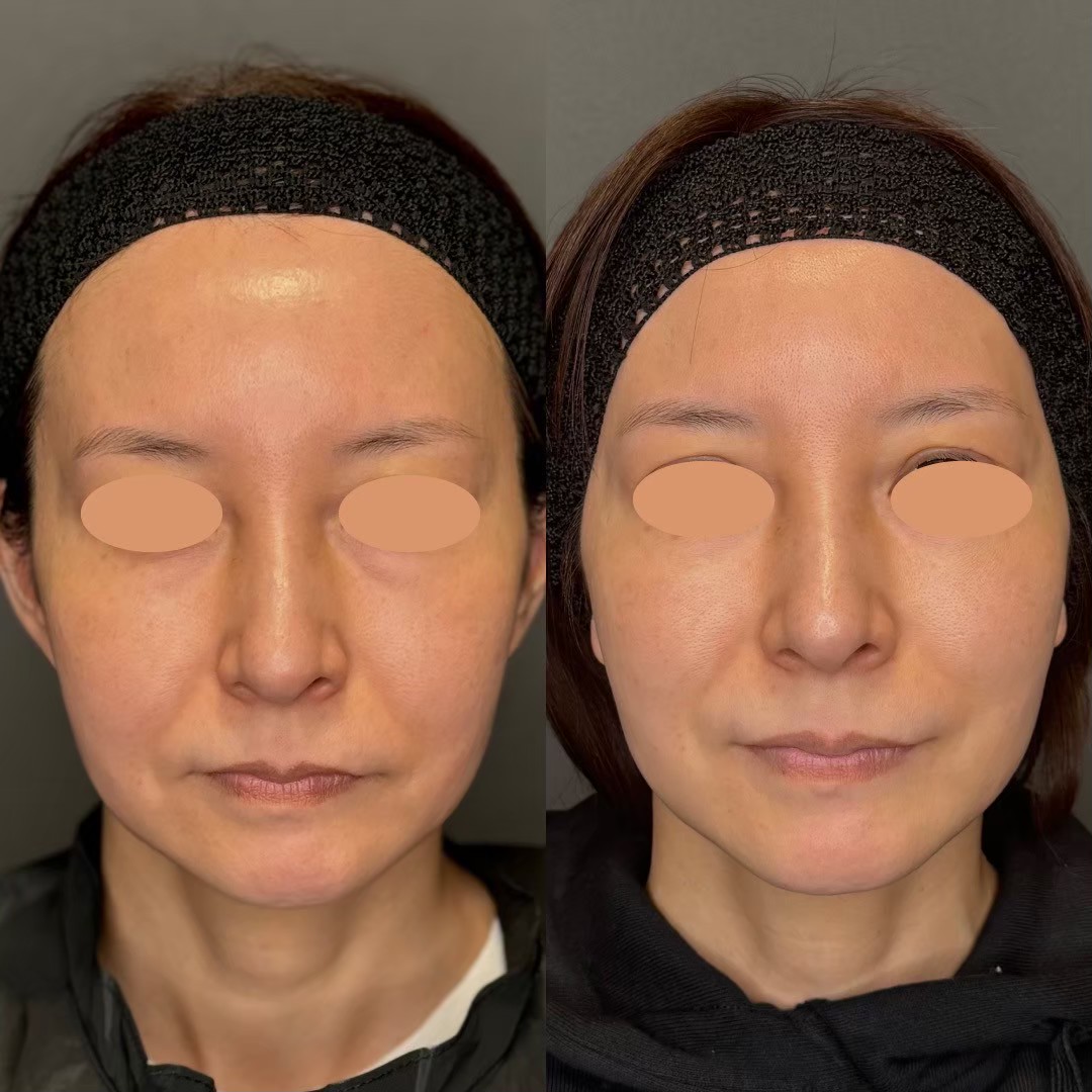 Volnewmer monopolar RF facial contouring — before/after by Dr. Jun Karibe