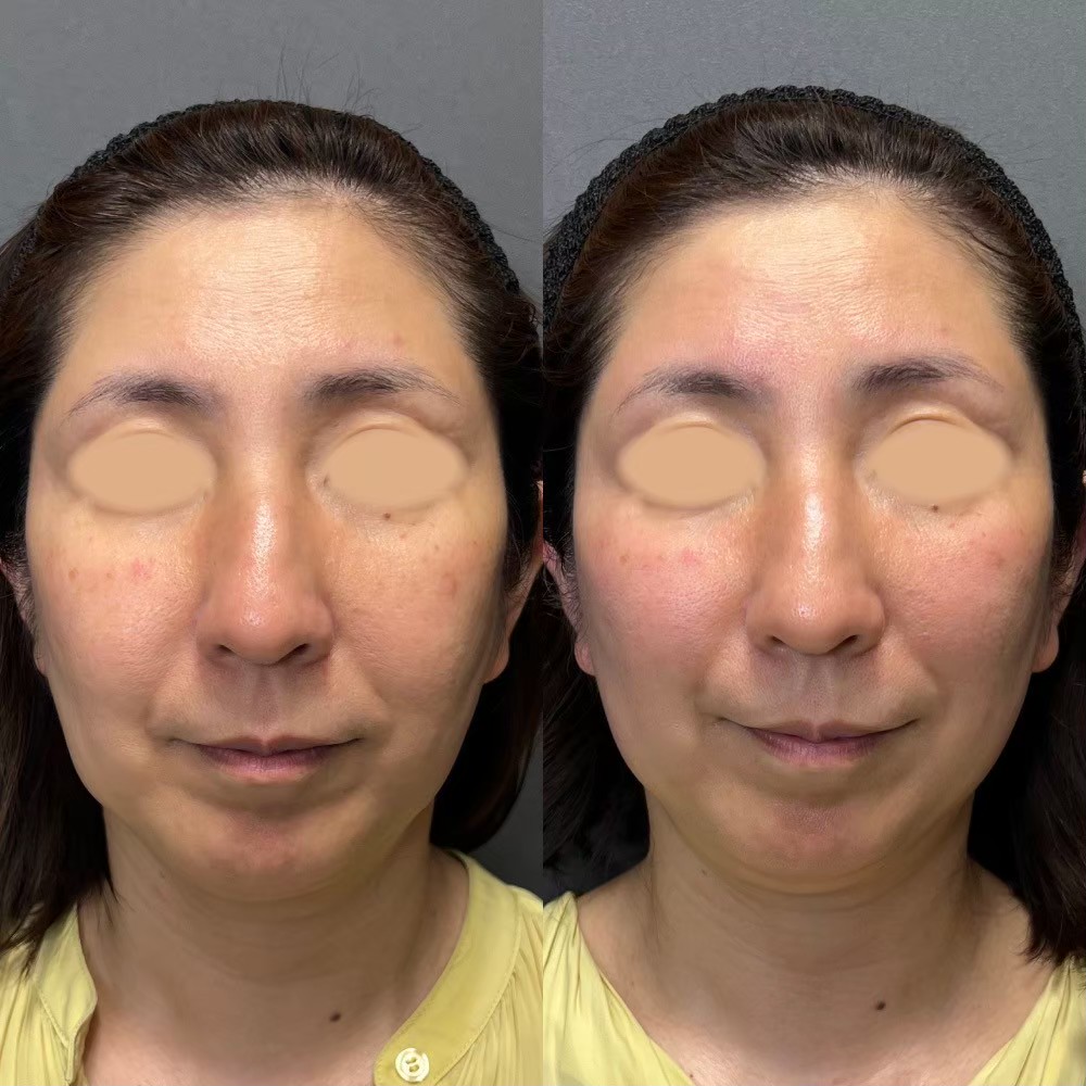 Volnewmer before and after — RF skin tightening result at BIOTOPE Clinic Tokyo