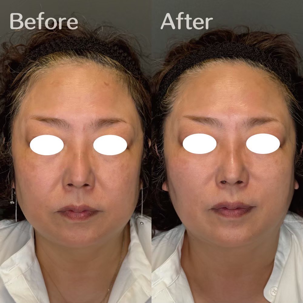 Volnewmer patient case — Tokyo BIOTOPE Clinic, cosmetic dermatology