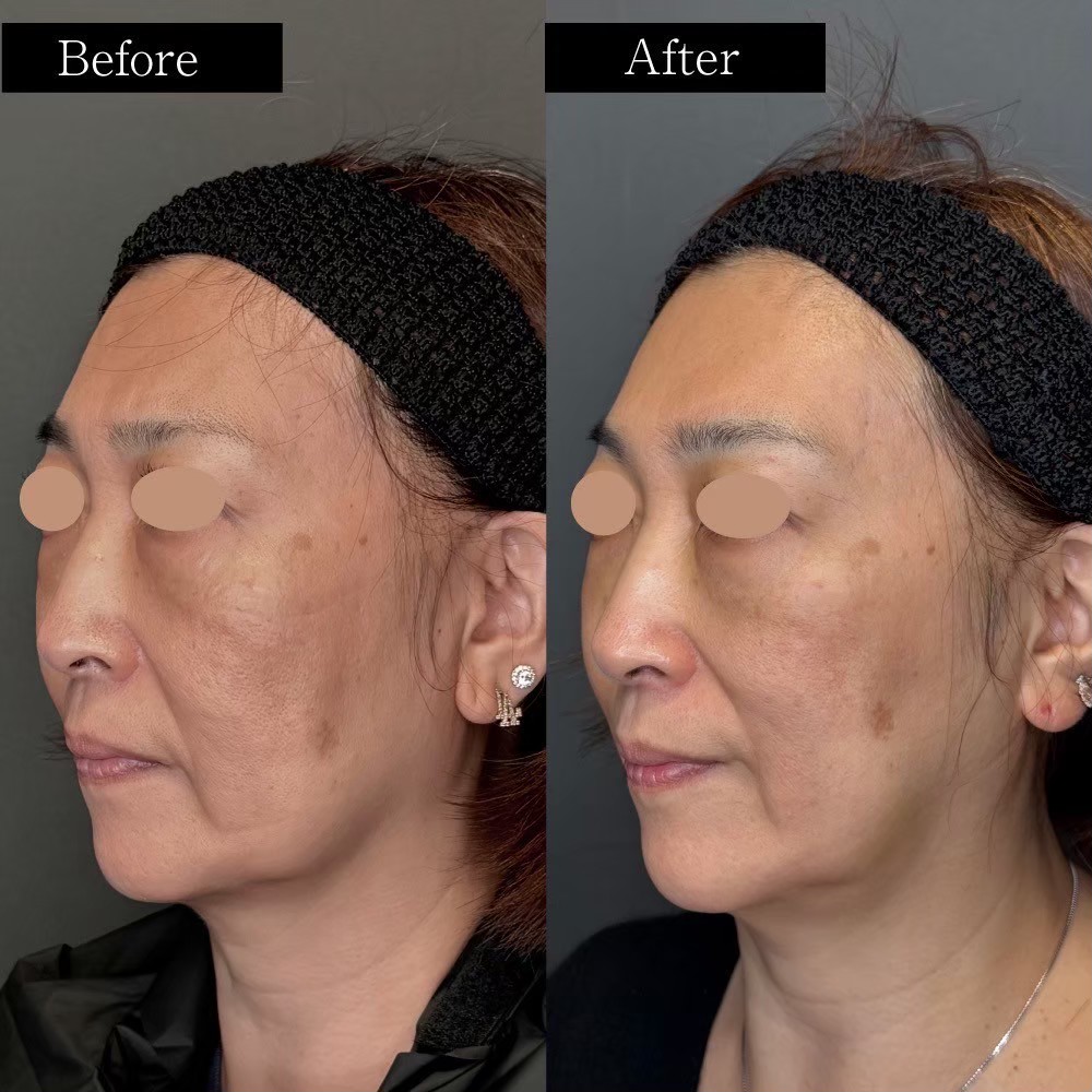 Volnewmer skin lifting result — Tokyo aesthetic dermatology case photo