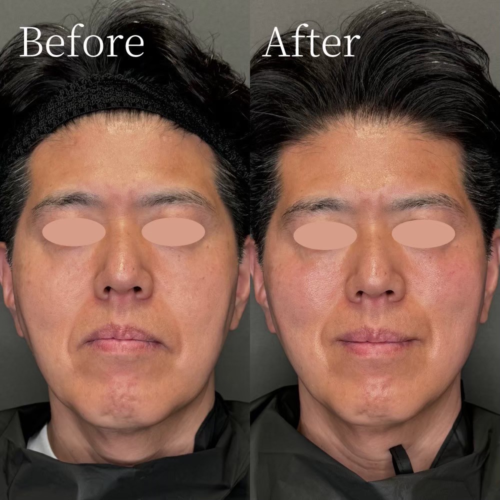 Volnewmer non-surgical facelift result — Dr. Karibe, board-certified plastic surgeon
