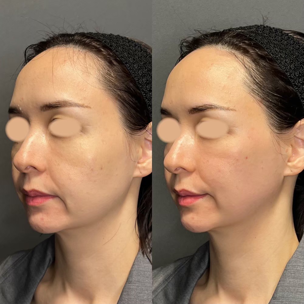 Volnewmer patient case — Tokyo BIOTOPE Clinic, cosmetic dermatology
