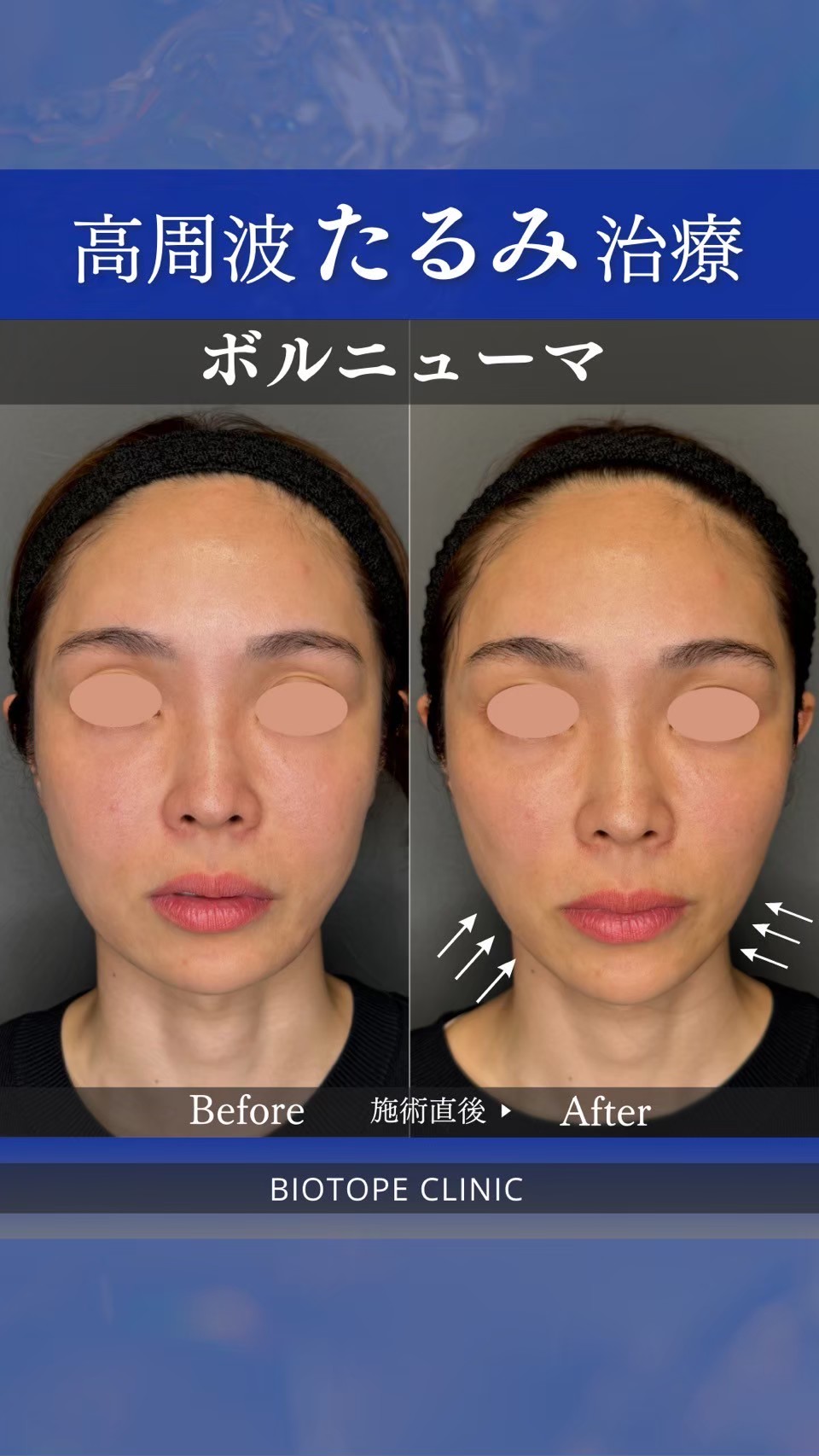 Volnewmer monopolar RF facial contouring — before/after by Dr. Jun Karibe