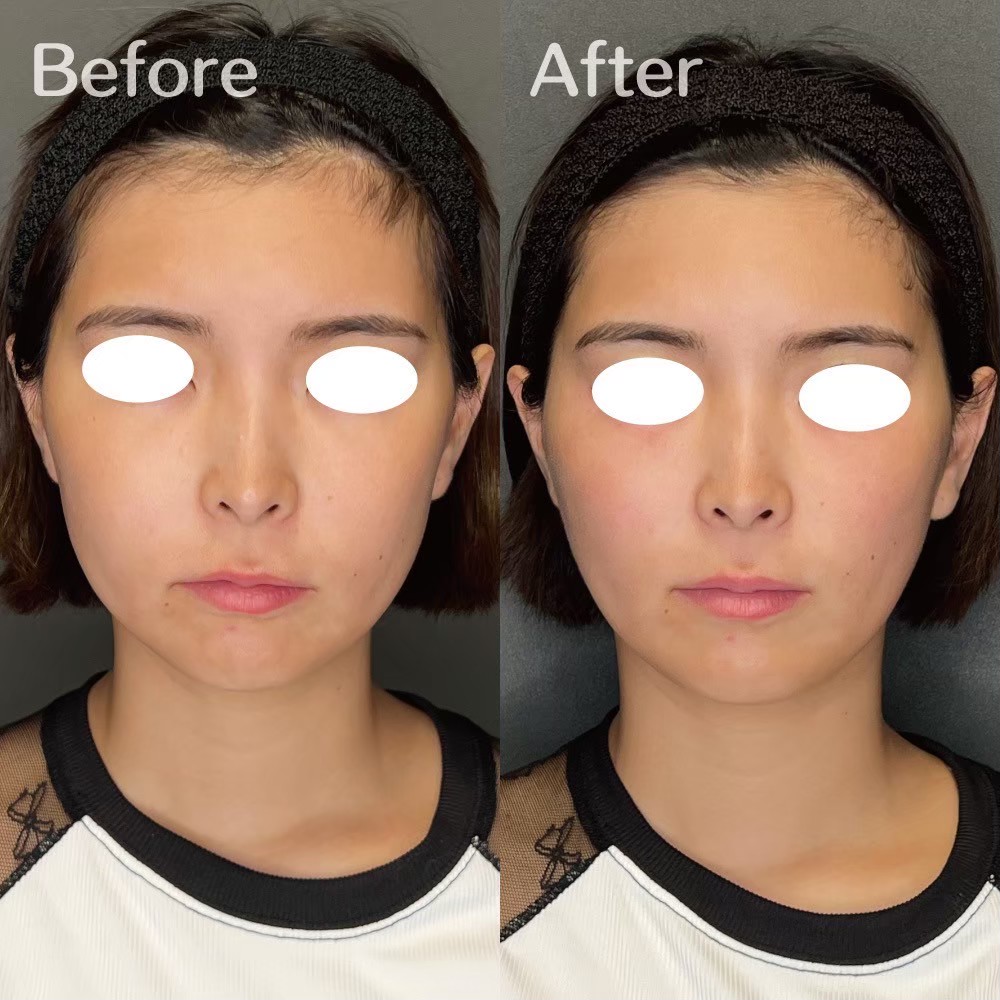 Volnewmer collagen remodeling result — RF skin tightening Japan