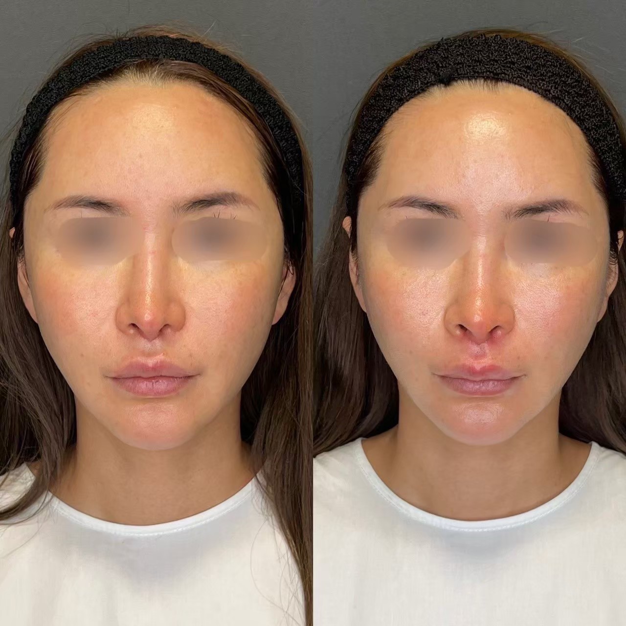 Volnewmer jawline tightening before and after — BIOTOPE Clinic Shirokanedai