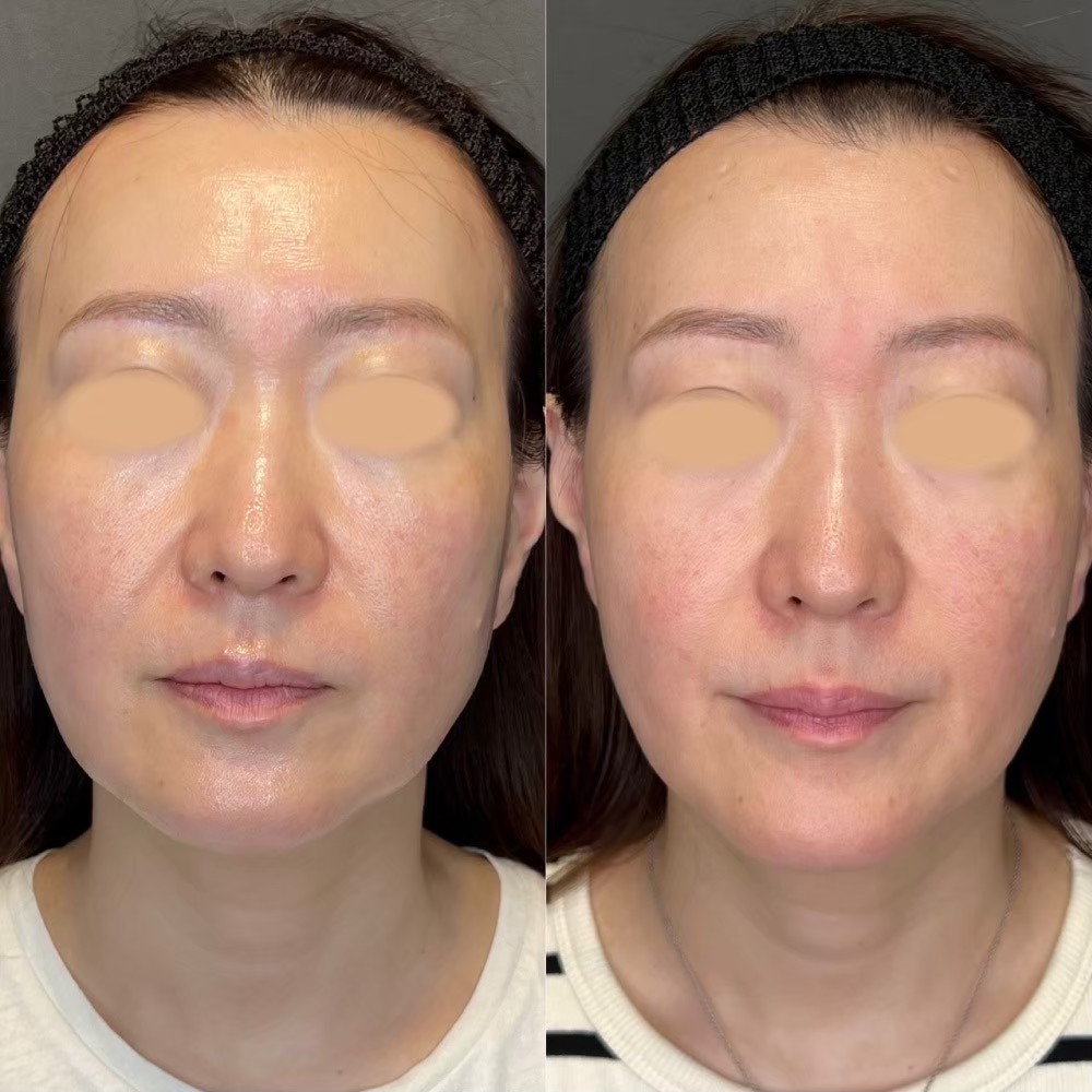 Volnewmer skin lifting result — Tokyo aesthetic dermatology case photo