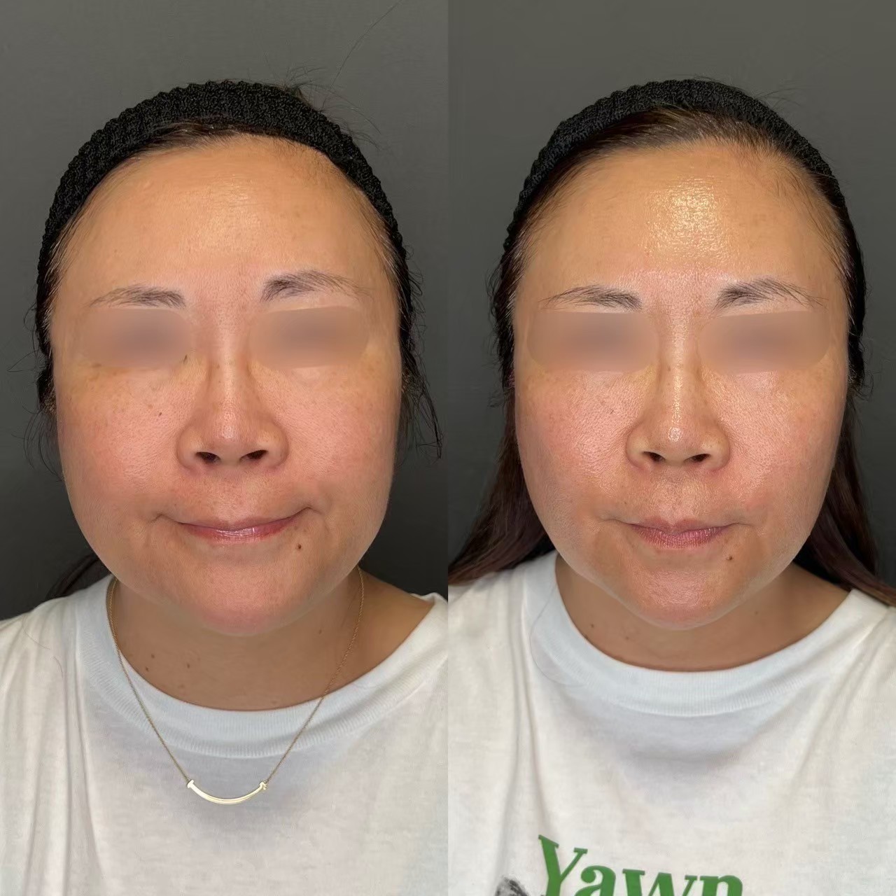 Volnewmer RF wrinkle and sagging treatment — Tokyo clinic case study