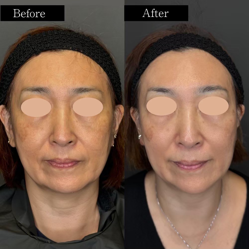 Volnewmer jawline tightening before and after — BIOTOPE Clinic Shirokanedai