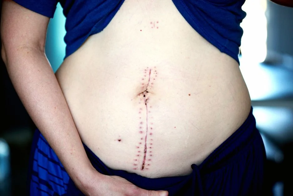 Scar revision surgery Tokyo: options and cost — Who Is a Good Candidate